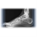 small x ray image of a foot