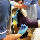 view of black castor sole units being measured on someones cast